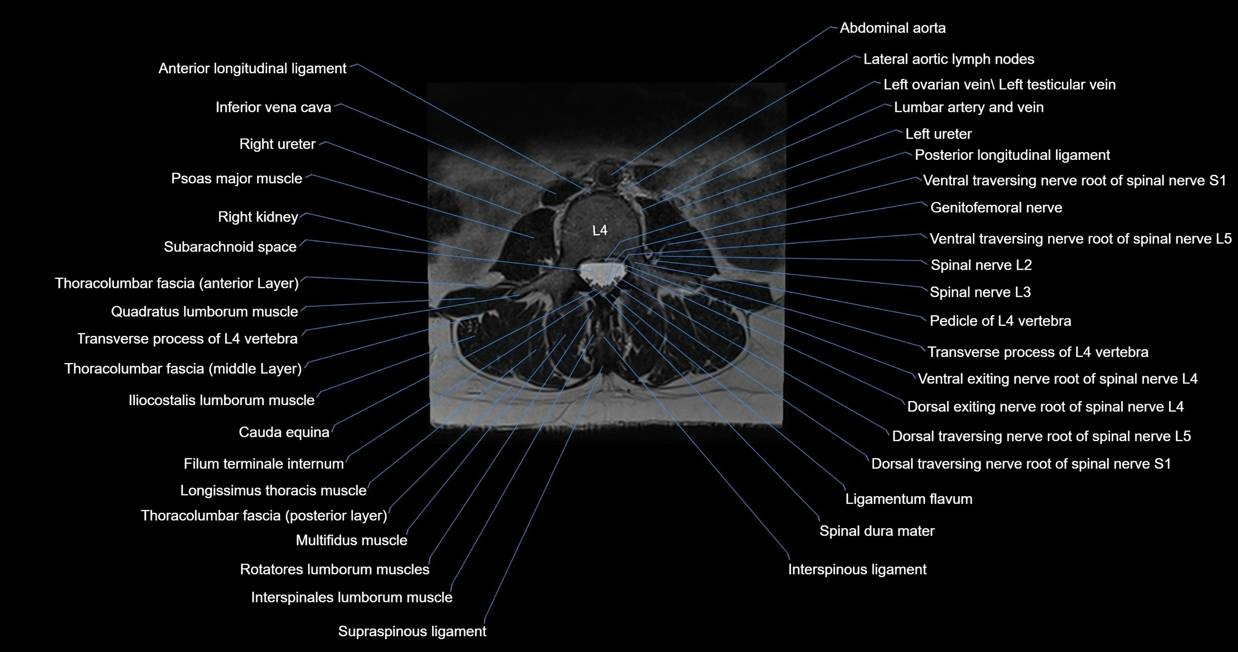 MRI lumbar spine axial cross sectional anatomy 3T radiology  image-img-00001-00029.webp